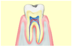 軽度のむし歯（C1）