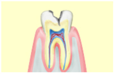 中度のむし歯（C2）