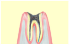 最重度のむし歯（C4）