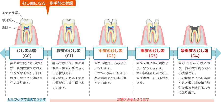 むし歯の進行と治療法