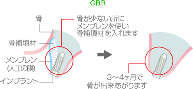 GBR(骨誘導再生)法
