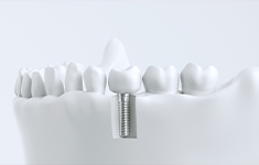 インプラント治療の人工歯の装着
