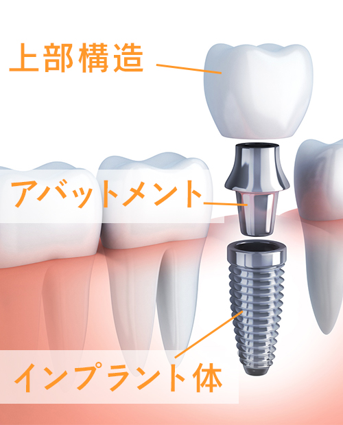 インプラントの構造